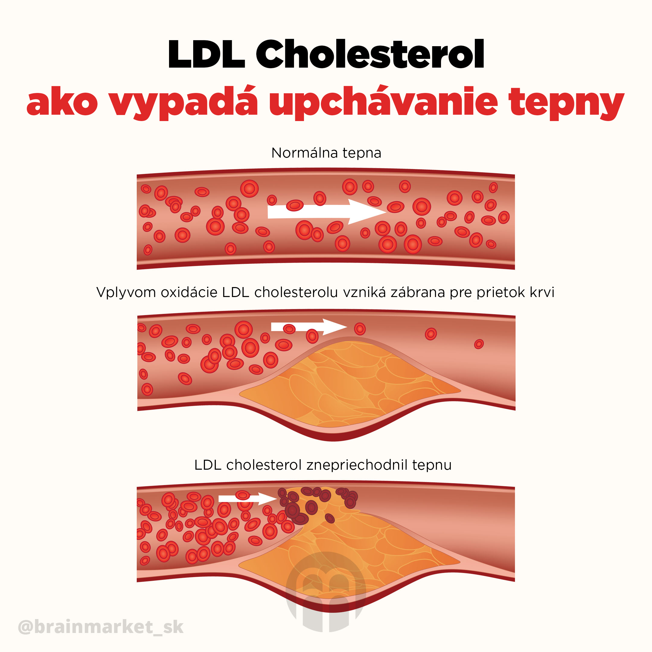 jak_probiha_ucpavani_tepny_infografika_brainmarket_CZ